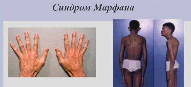 마르판 증후군 : 질병의 사진, 증상, 진단, 치료, 유전