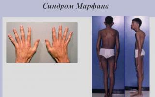Sindroma Marfan: foto, simptoma, diagnozë, trajtim, trashëgimi e sëmundjes